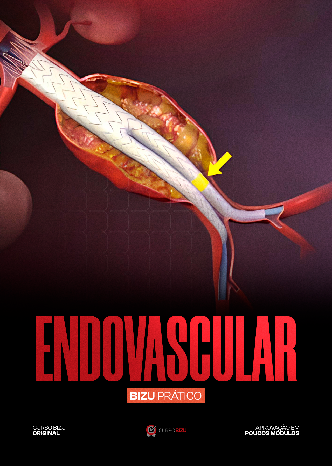 Curso Prtico para o ttulo de Angiorradiologia e Cirurgia Endovascular - Fase 2